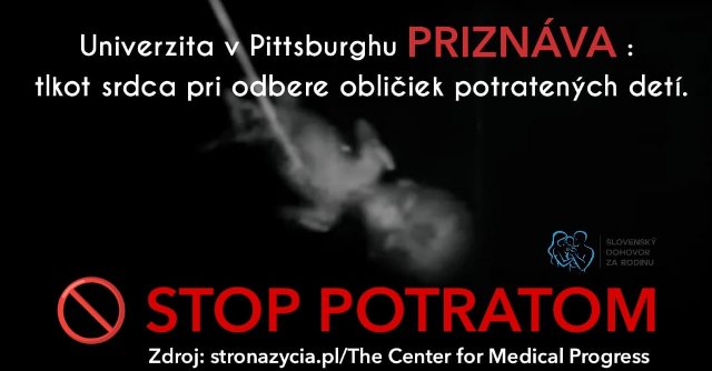 Univerzita v Pittsburghu priznáva tlkot srdca pri odbere obličiek potratených detí